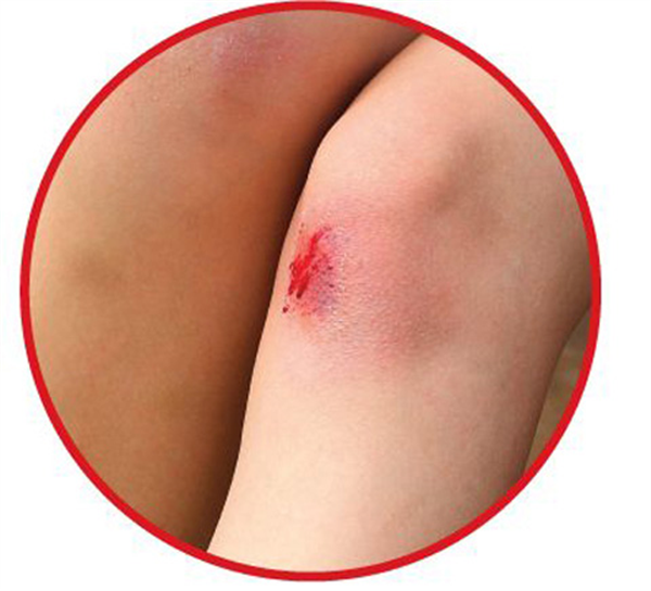 Bỏng bô ở nhượng chân sau đầu gối?